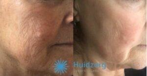 Cosmo Peel Forte - Voor en na de behandeling