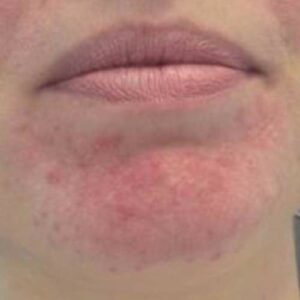 Rosacea huidziekte behandelen - Vaatafwijkingen behandelen - Huidzorg Klinieken