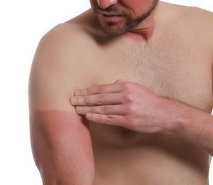 huid verbrand