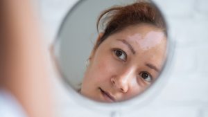 Pigment vlekken verwijderen