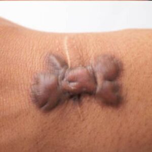 Keloid litteken behandelen - Littekens verwijderen - Huidzorg Klinieken
