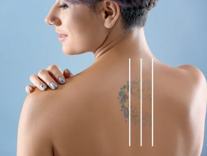 Tattoo Verwijderen resultaat