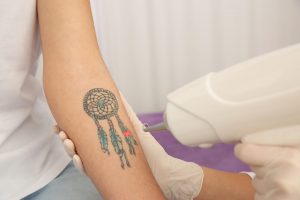 tattoeage weglaseren