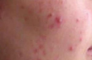 Acne (jeugdpuistjes) behandelen - Huidzorg Klinieken
