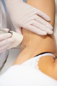 laser ontharen