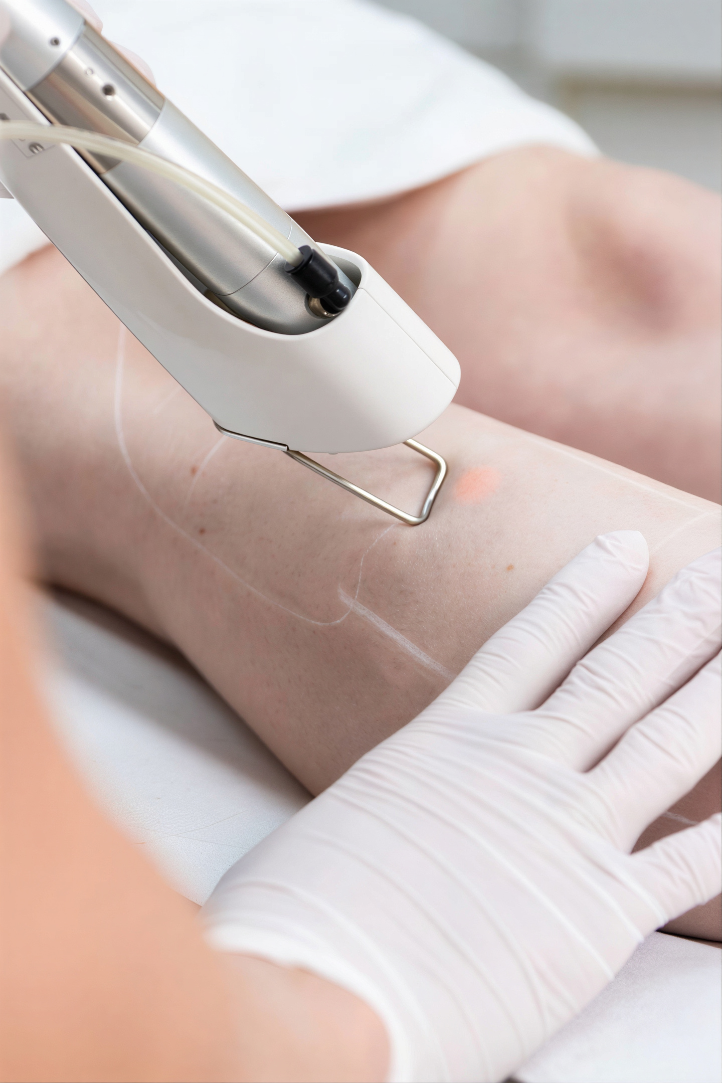 Laserontharing behandeling voor het verwijderen van ongewenste haargroei met langdurig resultaat