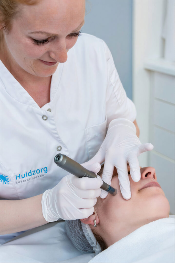Microneedling behandeling met pen voor huidverbetering en stimulatie van collageen