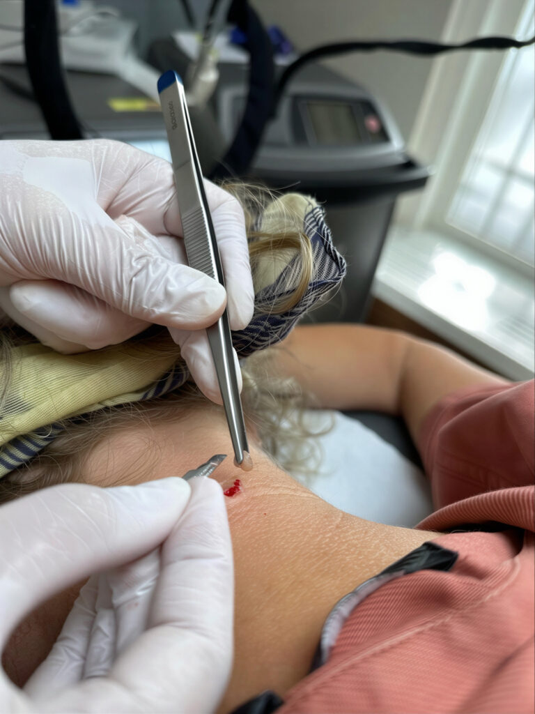 Laserbehandeling voor het verwijderen van moedervlekken en pigmentvlekken in professionele huidkliniek