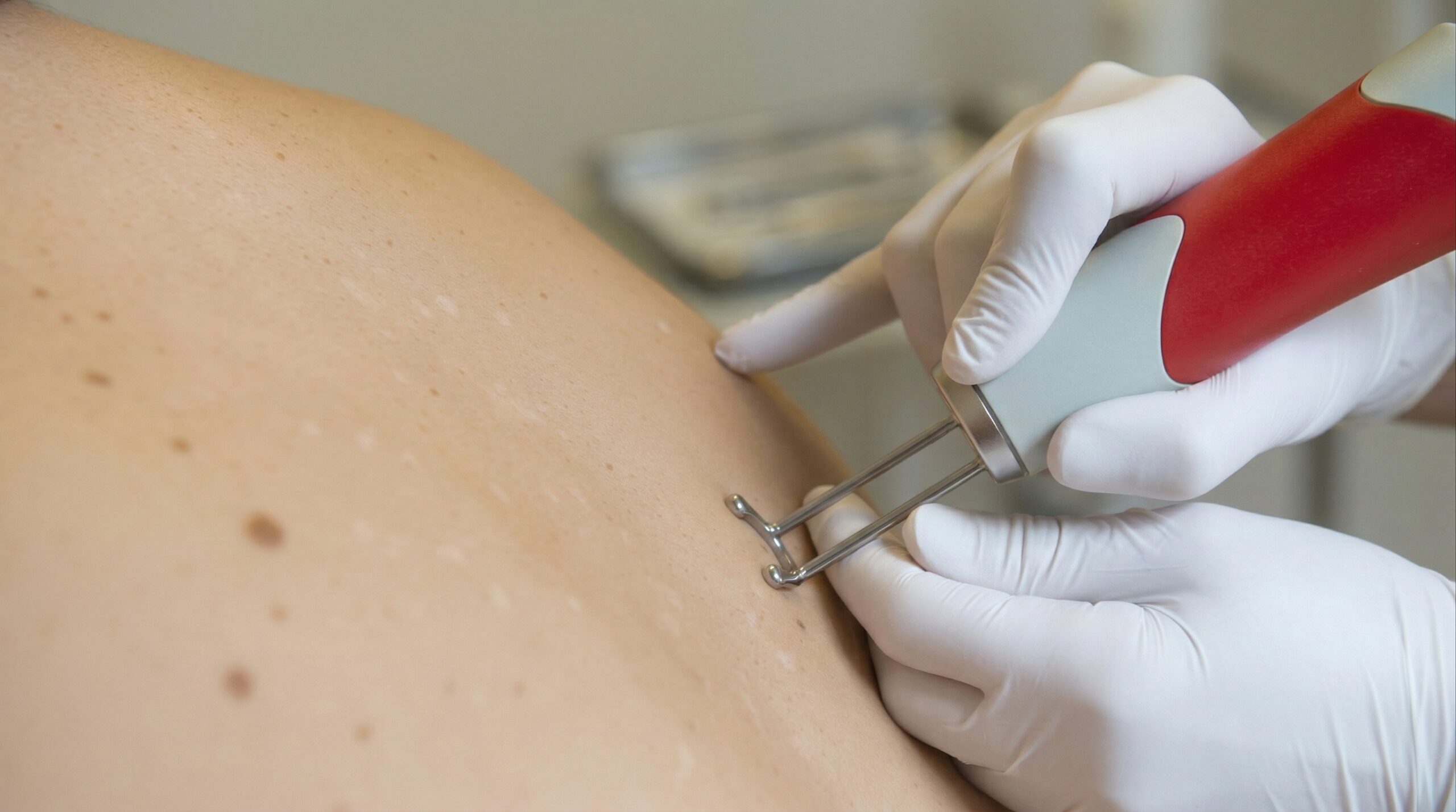 Laserbehandeling voor het verwijderen van ouderdomsvlekken en het verhelderen van de huid