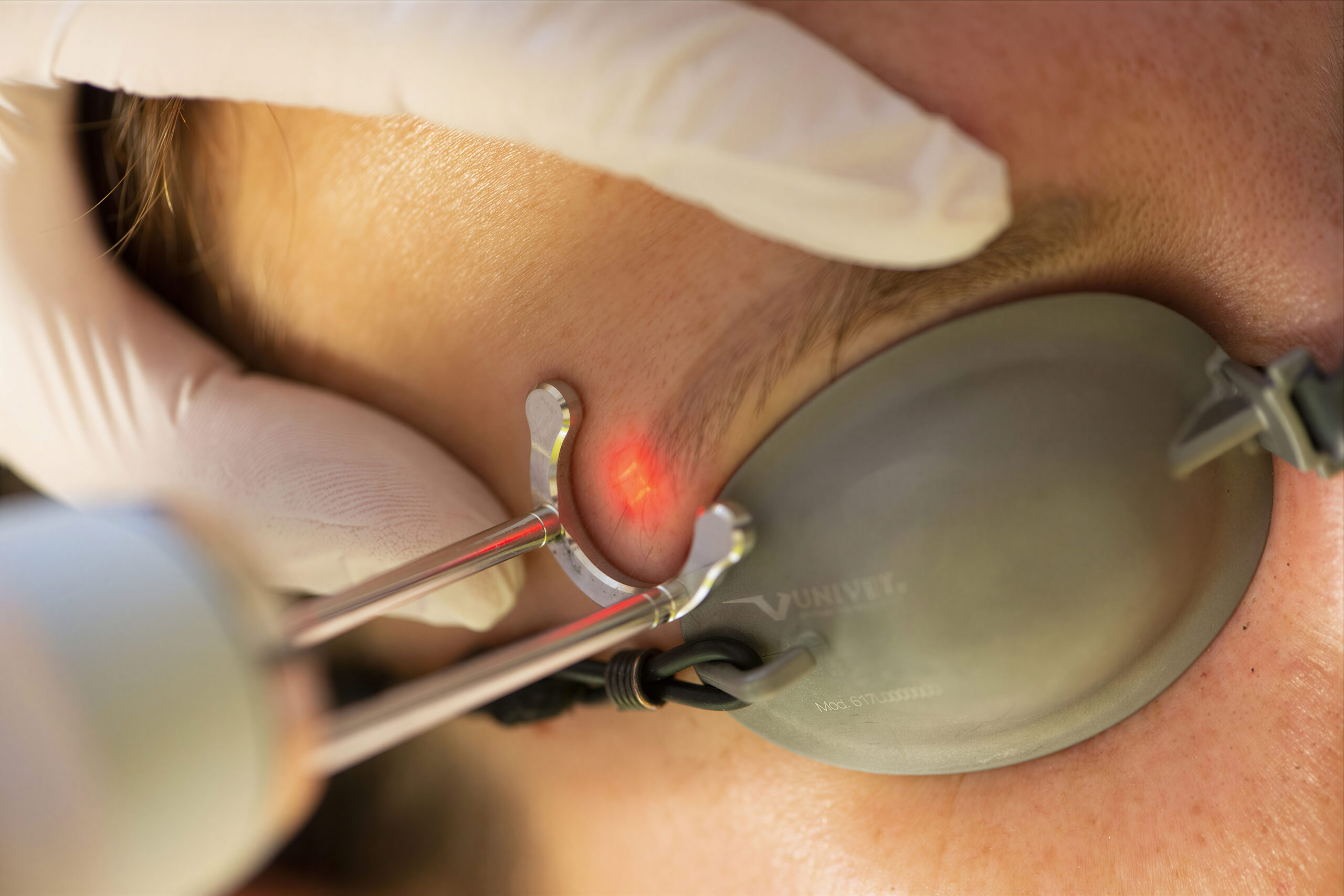 Laserbehandeling voor het verwijderen van permanente make-up zoals wenkbrauwen en eyeliner