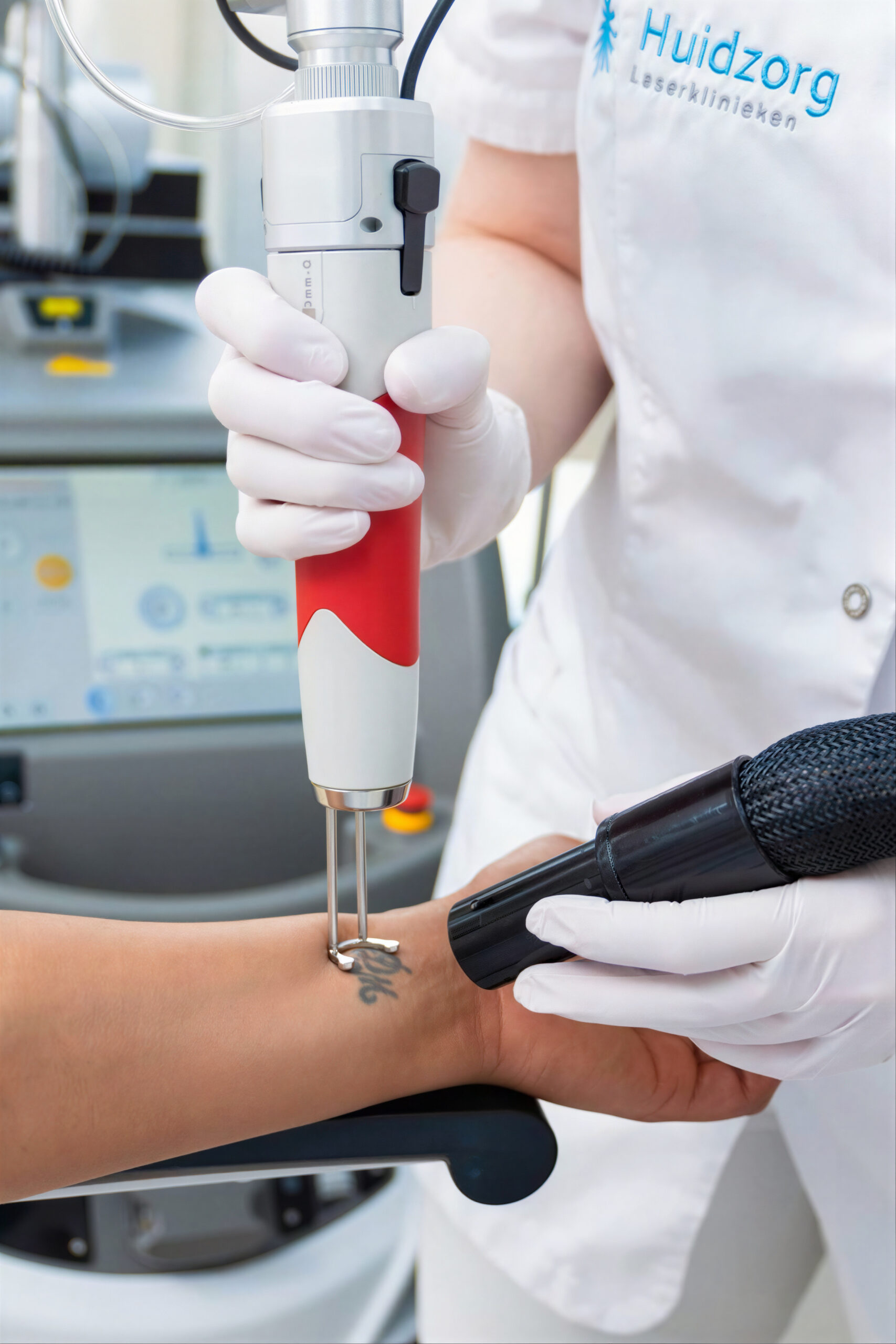 Laserbehandeling voor het verwijderen van tatoeages met geavanceerde technologie