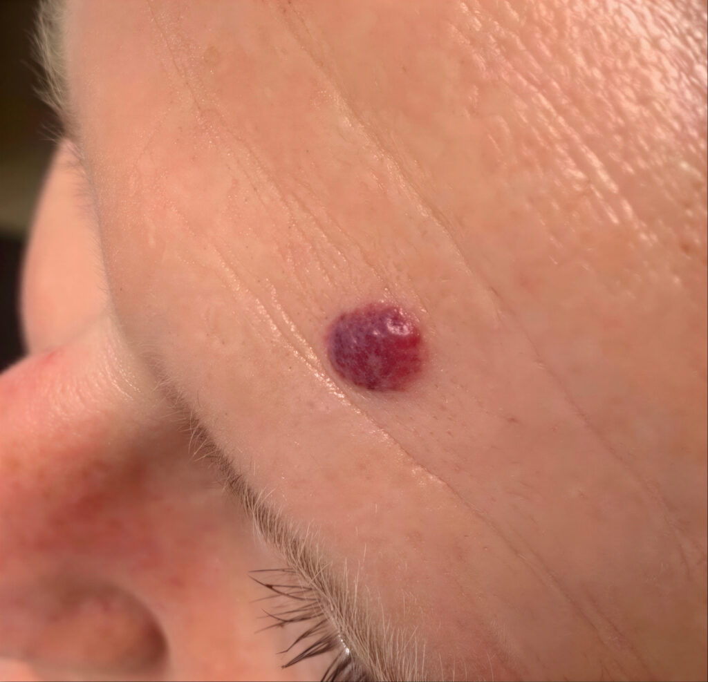Laserbehandeling voor het verwijderen van angiomen en kleine rode vaatbultjes