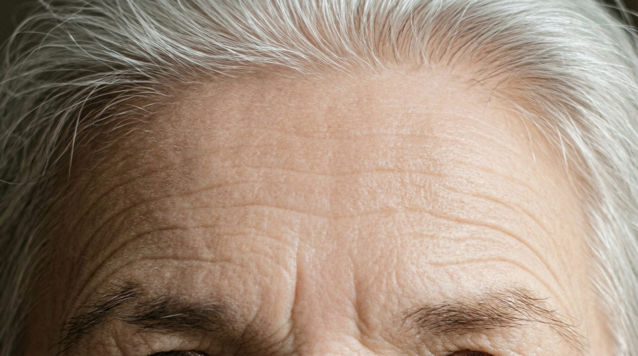 Behandeling van fijne lijntjes met combinatie van peeling, microdermabrasie en laser