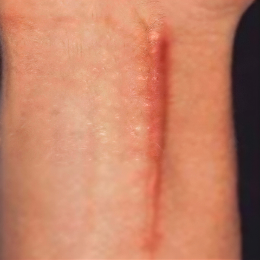 Behandeling van hypertrofische littekens met lasertherapie voor het verminderen van verdikking en roodheid