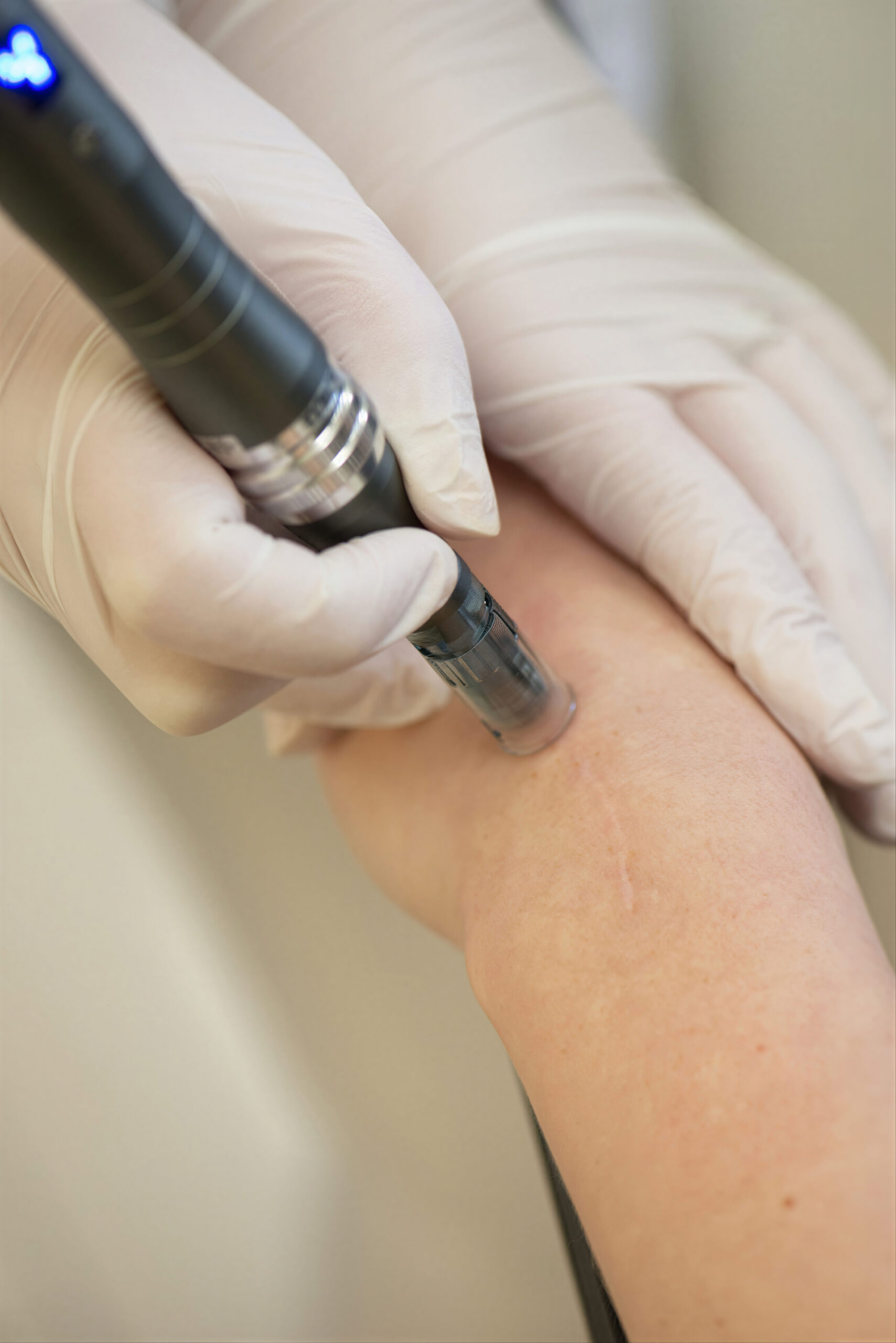 Laserbehandeling voor littekens met focus op huidverbetering en egalisatie