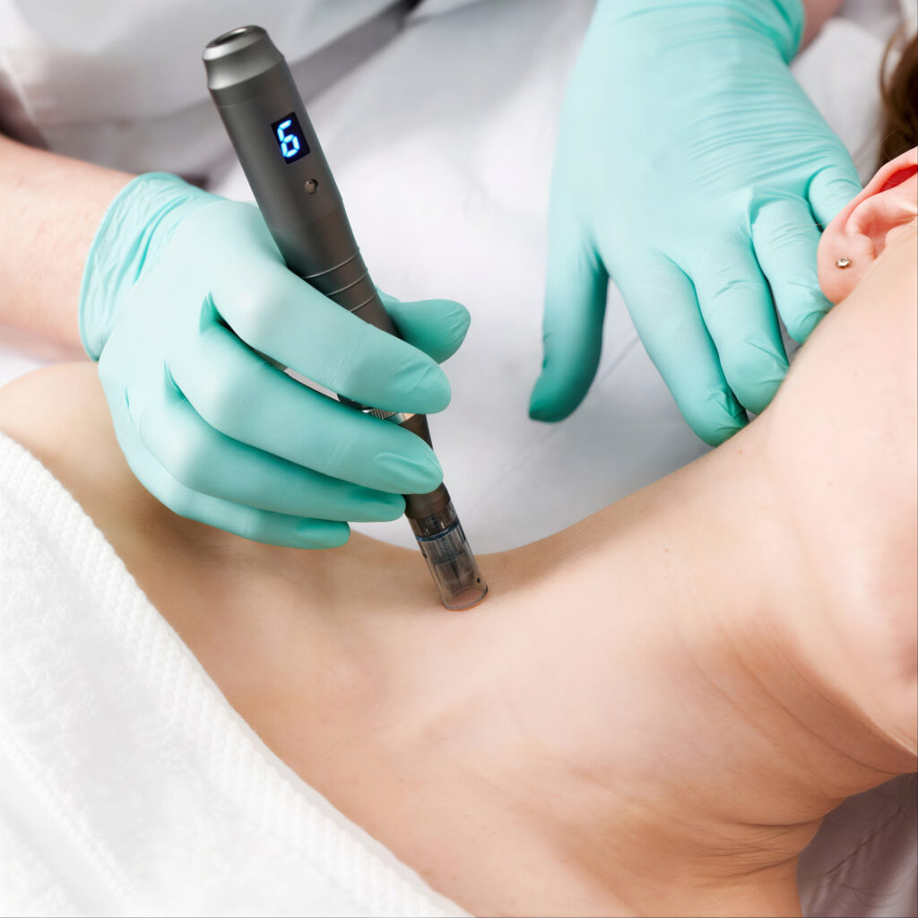 Diepe microneedling behandeling (Firm Facial) voor huidversteviging en vermindering van rimpels en littekens