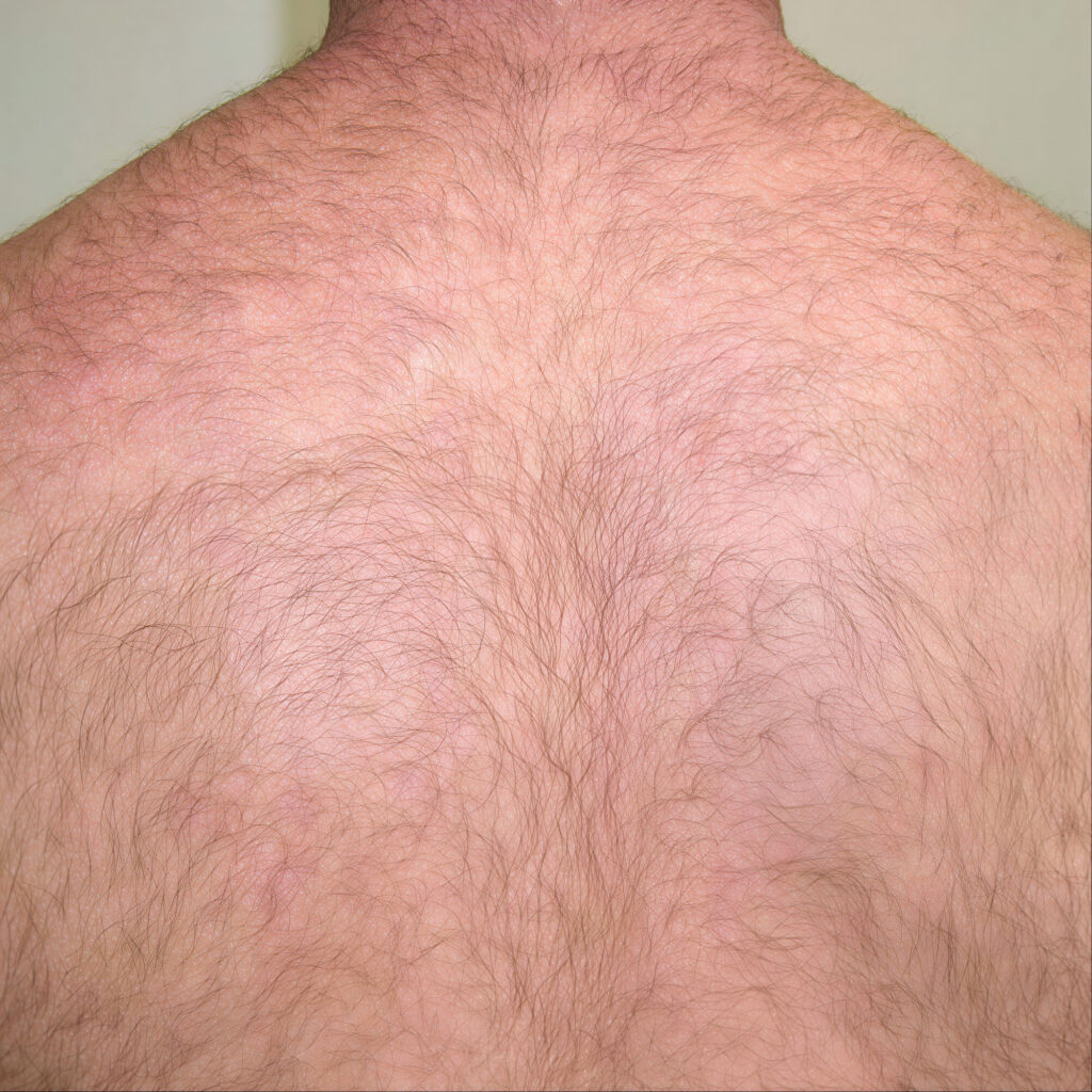 Laserontharing van de rug voor het verminderen van overmatige haargroei