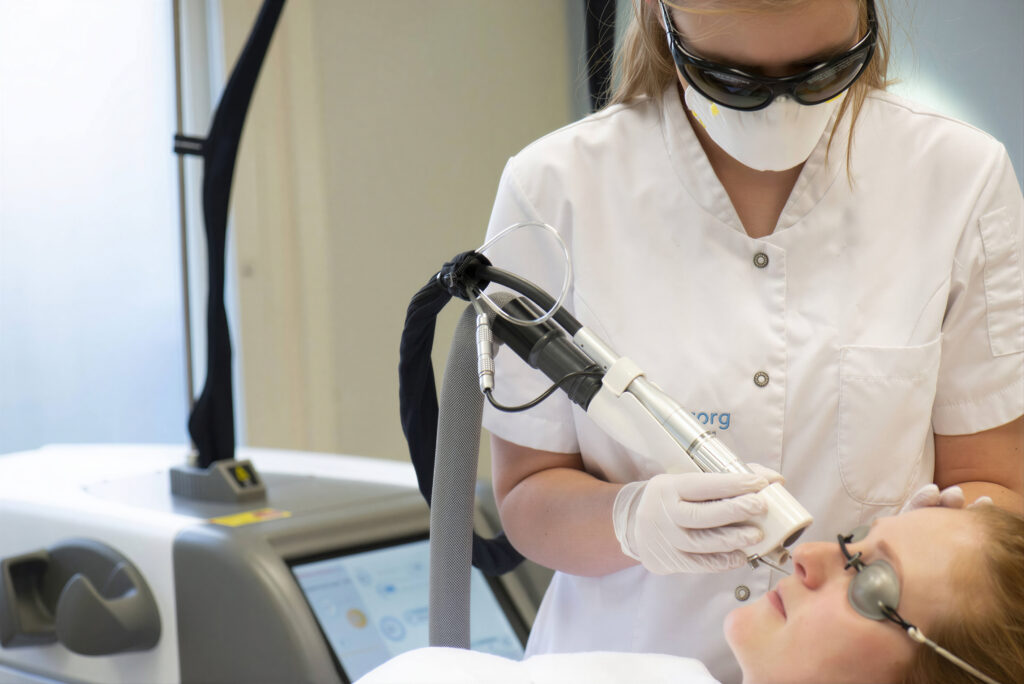 Laserbehandeling voor het verwijderen van spider naevus met focus op zichtbare vaatjes