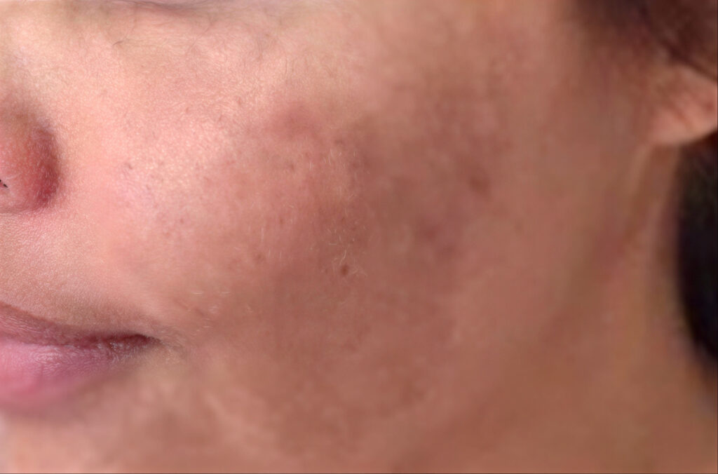 Behandeling van melasma met focus op het verminderen van pigmentvlekken en egaliseren van de huid