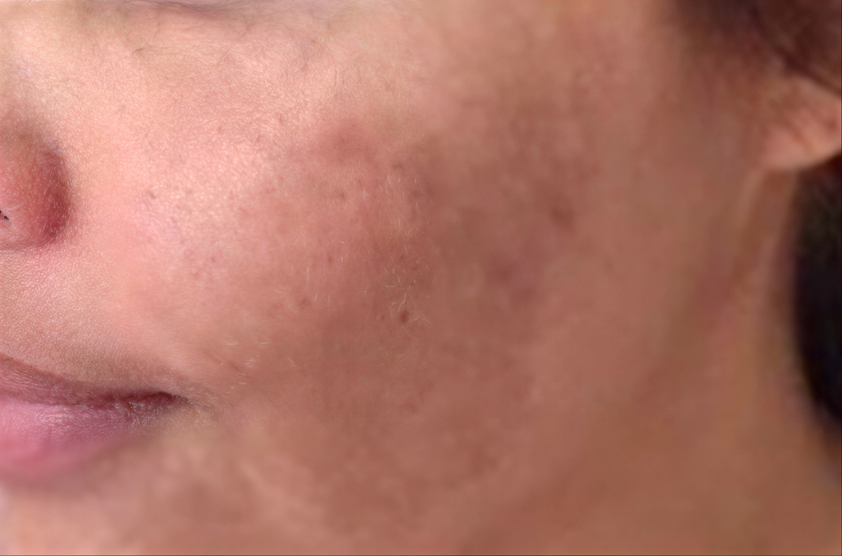 Behandeling van melasma met focus op het verminderen van pigmentvlekken en egaliseren van de huid